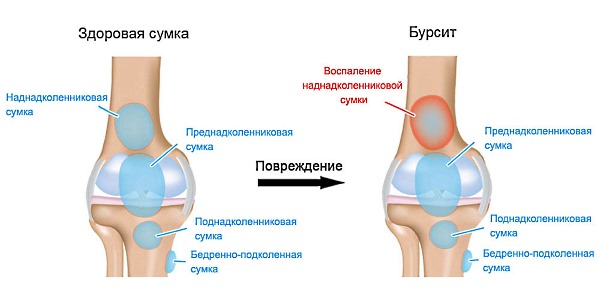 Бетаспан Депо можно использовать при бурситах и артрите суставов