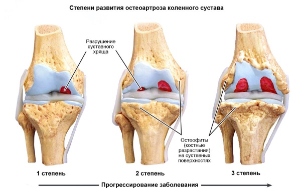 Лекарственное средство назначают при различных типах остеоартроза