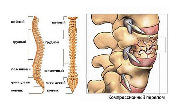 Чаще всего от компрессионного перелома страдают грудные и поясничные позвонки