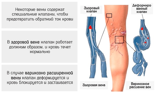 Благодаря троксерутину Индовазин можно применять при венозной недостаточности нижних конечностей