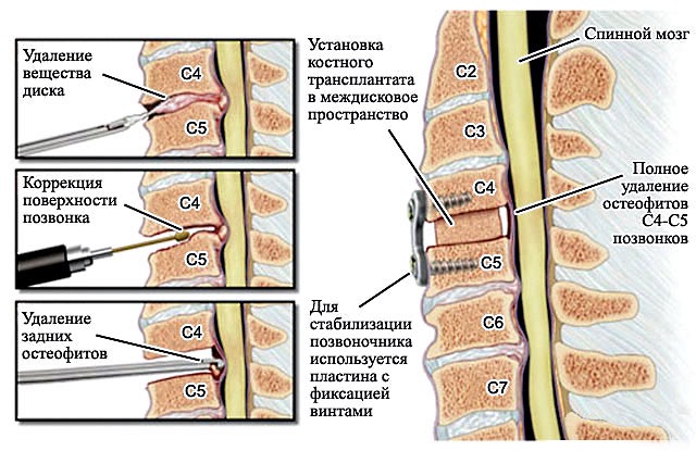 Хирургическое лечение требуется, если произошла компрессия нервных корешков