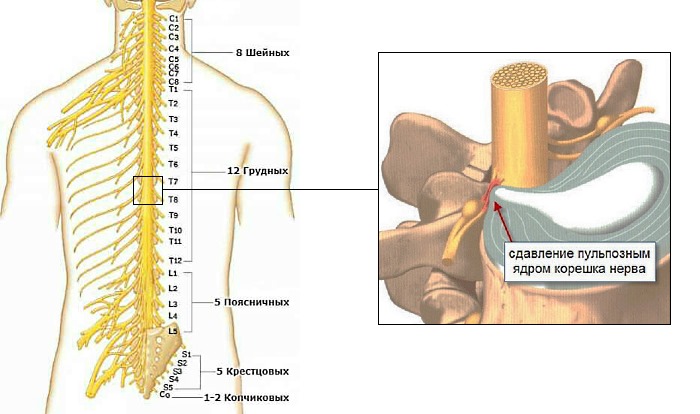 Используют Аквацитрамон при корешковых синдромах и других неврологических заболеваниях