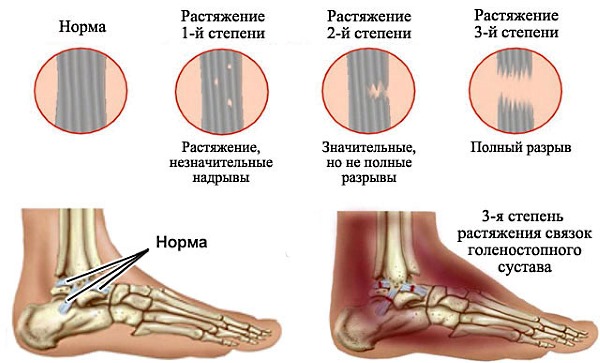Кетофрил помогает справиться с болью при различных травмах и растяжениях