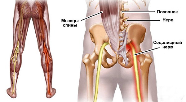 Иногда Саридон используют для устранения симптомов защемления седалищного нерва