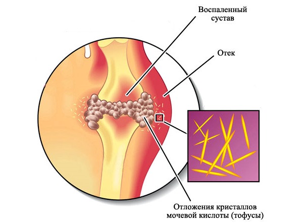 Отложение солей происходит преимущественно в суставах
