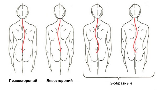 Самое частое заболевание позвоночника у подростков - сколиоз