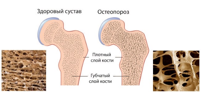 Остеопороз возникает в следствии вымывания кальция и фосфора из костей