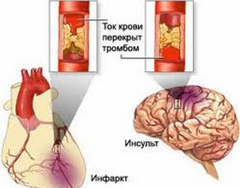 перекрытие тромбом