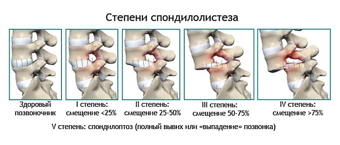 5 степень спондилолистеза характеризуется полным выпадением позвонка