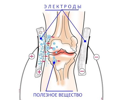 При терапии электрофорезом лечение дополняют специальным лекарством, которое доставляется в пораженные ткани с помощью прибора
