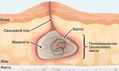 Пилонидальная болезнь - очень опасное заболевание, которое перетекает в абсцесс и вызывает очень сильные боли в копчиковой части позвоночника