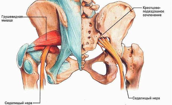 Ишиас возникает из-за воспаления или ущемления одного из корешков седалищного нерва