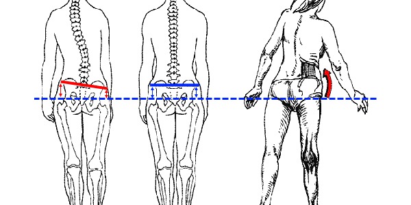 При поясничном сколиозе наблюдается асимметрия тазовых костей
