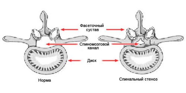 Стеноз позвоночника - сужение спиномозгового канала