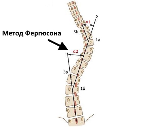 Метод Фергюсона не позволяет измерять искривления больше 50 градусов