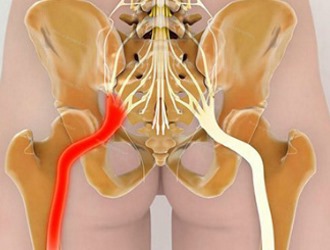 Массаж не применяют при обострении ишиаса