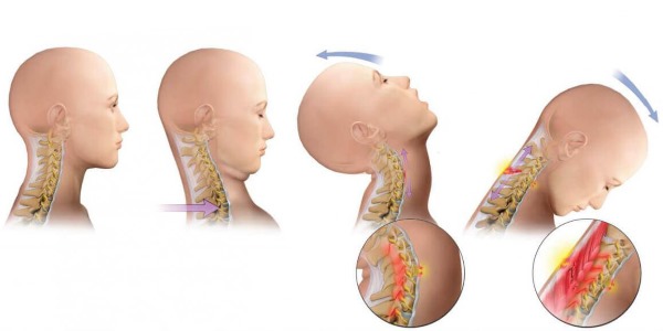 Шейный отдел повредить намного проще, чем другие области позвоночника