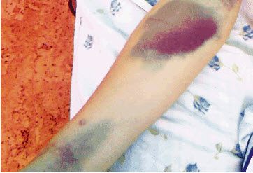 проявления на коже