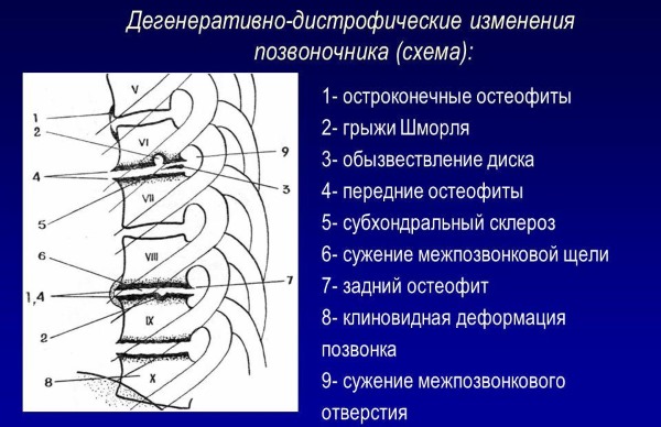 Чаще всего используют Диклофенак Натрия при патологиях суставов и позвоночника