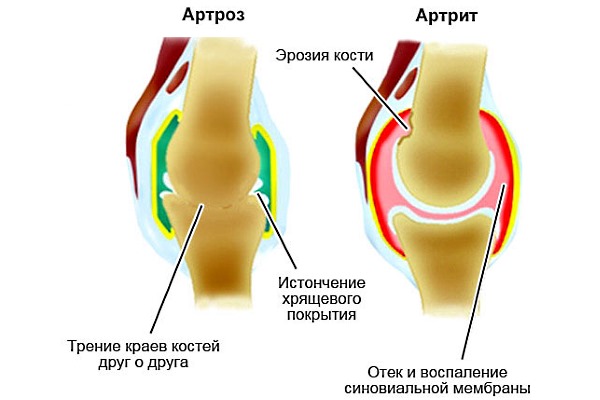 Обратите внимание чем артроз отличается от артрита