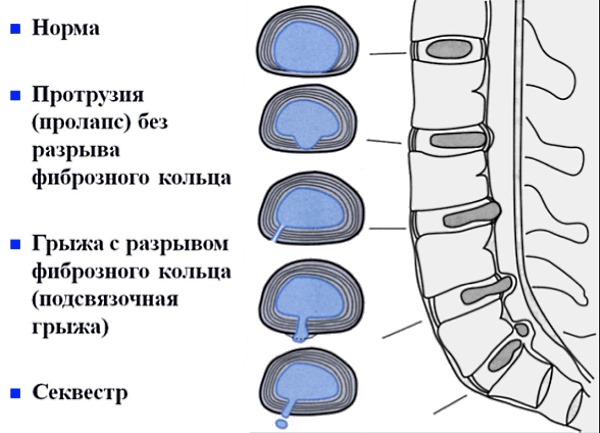 Стадии развития межпозвоночной грыжи