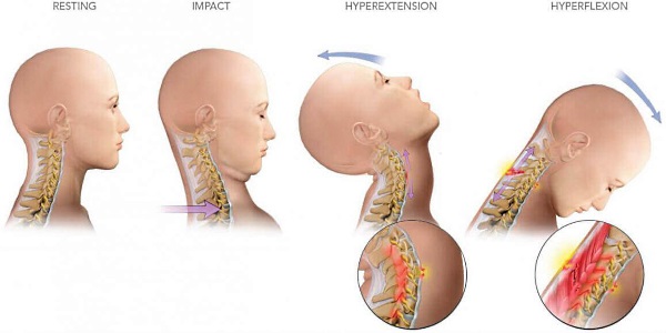 Травмы также являются частыми причинами болевого синдрома в шее