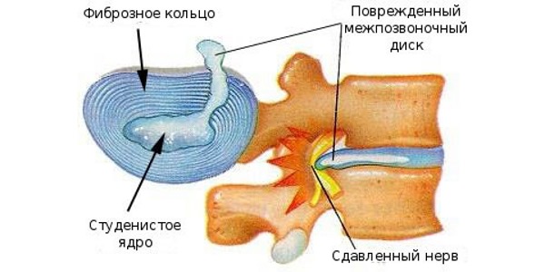 Грыжа грудного отдела тяжело диагностируется, поэтому ее часто обнаруживают в запущенных стадиях