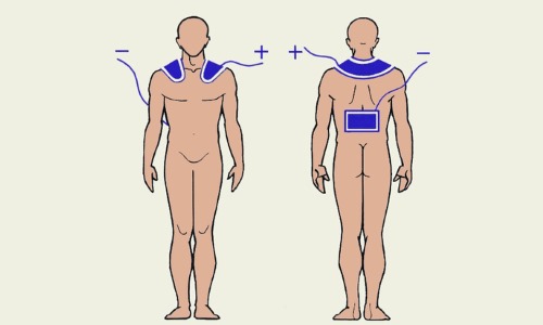 При грыже в шейном и грудном отделе электроды устанавливают в районе шеи и поясницы