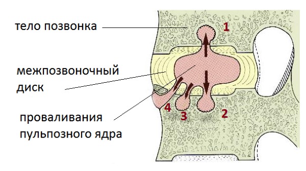 Грыжа Шморля - продавливание межпозвонкового диска в позвонок