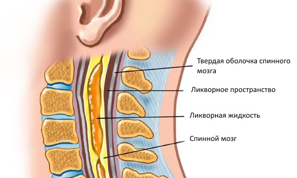 Сирингомиелия - образование пустот в спинном мозге