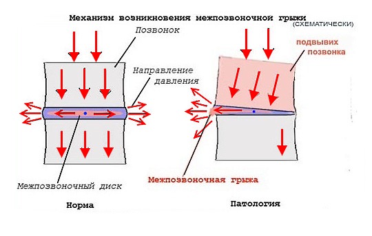 Схематический пример образования межпозвоночной грыжи
