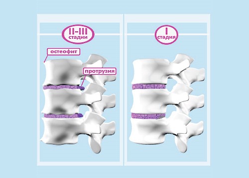 На 2 этапе развития остеохондроз можно диагностировать без особой проблемы