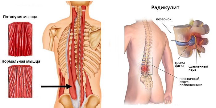 Панадол можно использовать при болях в спине и мышцах