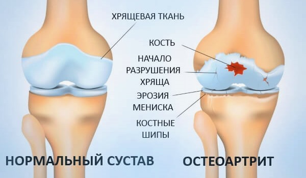 В основном препарат Диамакс применяют при остеоартрозе и остеоартрите