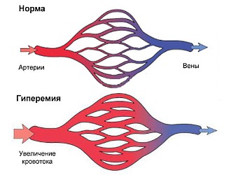 Финалгон вызывает гиперемию кожных покровов