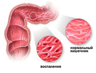Паноксен противопоказан при воспалении кишечника