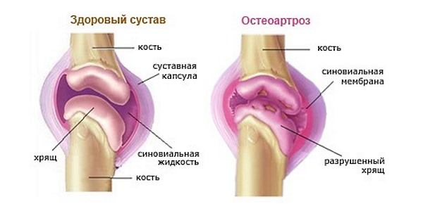 Остеоартроз, артроз, остеохондроз - показания к использованию Мукосата
