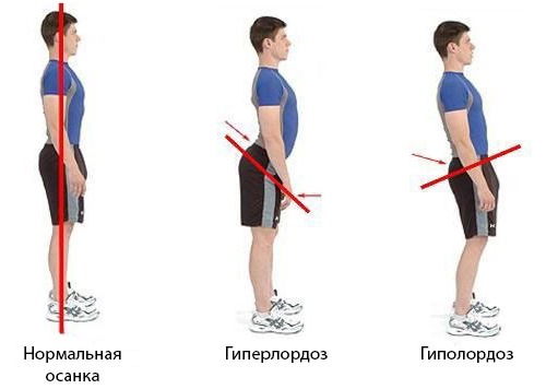 Нарушения в изгибе поясничного отдела обычно возникают в детском возрасте