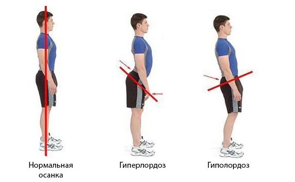 Изгиб в пояснице может как увеличится - гиперлордоз, так и уменьшиться - гиполордоз