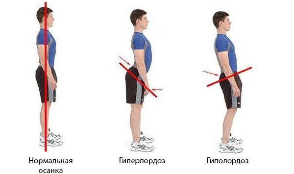 При лордозе изгиб позвоночника обращен вперед