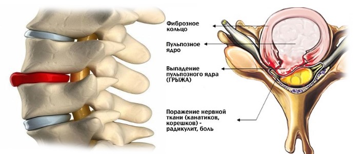 Грыжа межпозвонкового диска возникает из-за неравномерной нагрузки на позвоночник