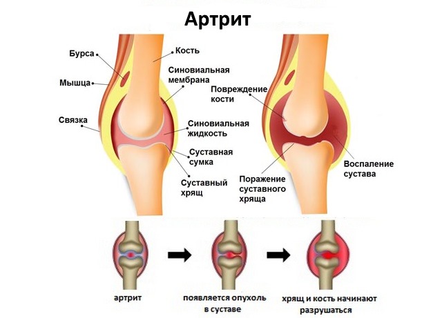 В основном Фламидез используют при болях в суставах и костях