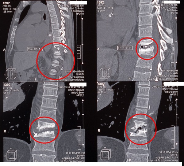 КТ позвоночника при туберкулезе