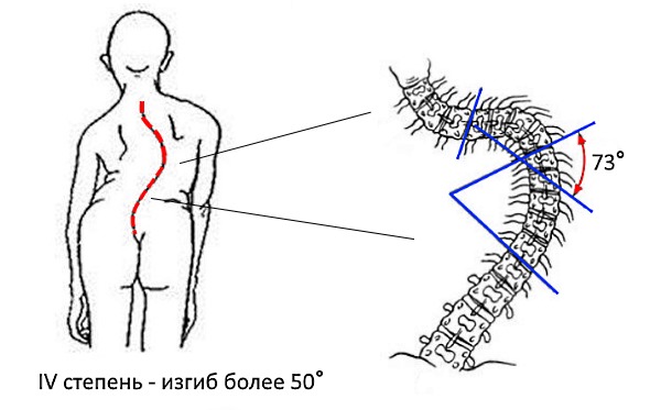 Обратите внимание на то, как изогнут позвоночник при сколиозе 4 степени