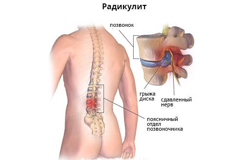 При помощи Нимесулида Канон можно устранить боль в пояснице