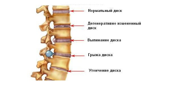 Часто хондроз перетекает в протрузию и грыжу диска