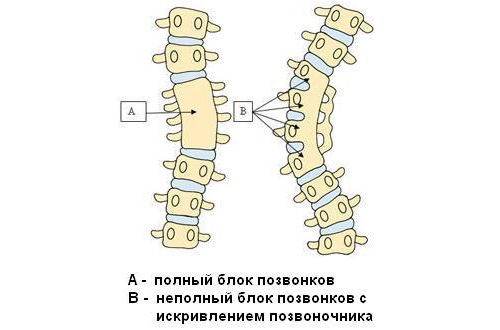 При конкресценции шейных позвонков происходит их сращивание