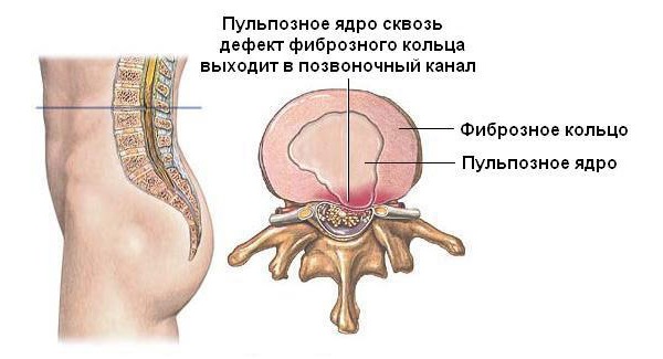 Лечебную физкультуру запрещено делать при обострении грыжи