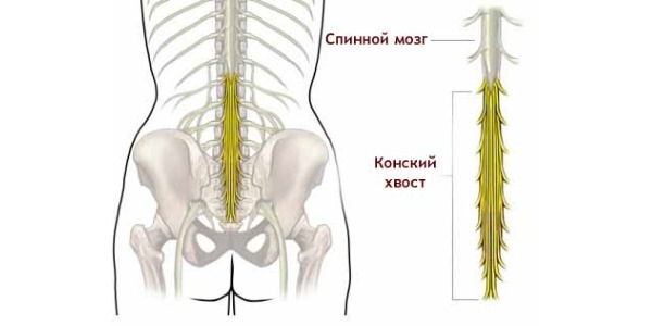 Операция требуется при повреждении нижней части спинного мозга - конского хвоста
