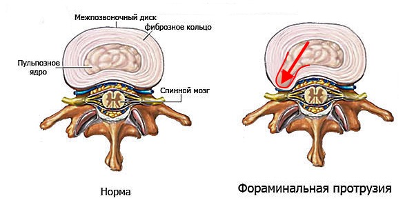 Главная опасность фораминальной протрузии в том, что она направлена в сторону спиномозгового канала